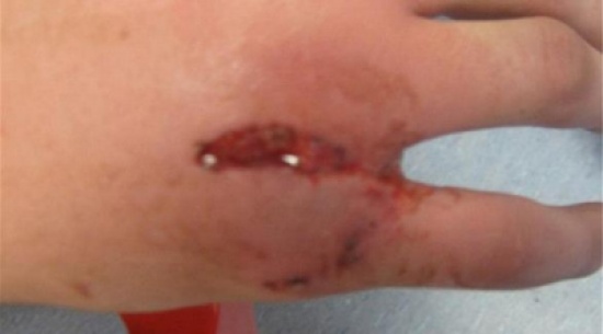 يلكم وجه أخيه...فتتورم يده ويجري عملية جراحية فيها