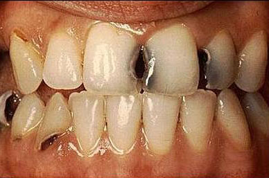 8 آلاف طالب وطالبة مصابون بنخر الاسنان في عجلون 