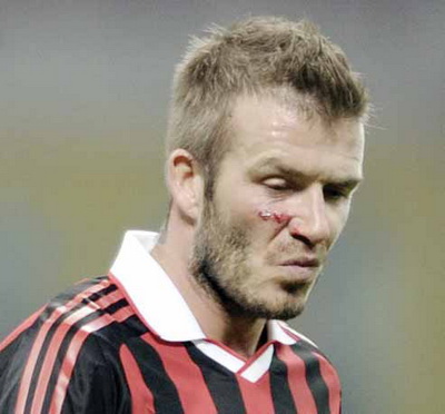 كابيللو يستدعي بيكهام للمونديال رغم الاصابة