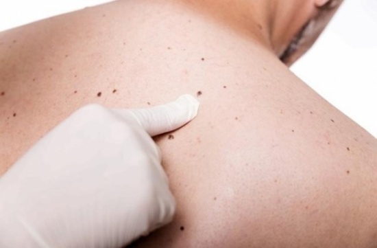 عزيزي الرجل: ماذا تعرف عن سرطان الجلد؟ عزيزي الرجل: ماذا تعرف عن سرطان الجلد؟