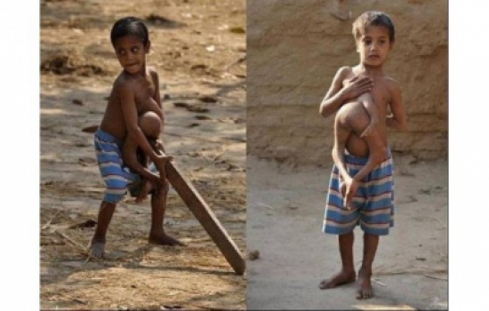 الطِّفل الأخطبوط في الهند!! " صور"