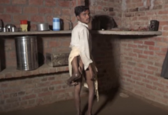 يعيش على أمل التخلص منها .. شاب بـِ”ذيل” مكون من ساقين إضافيتين في ظهره! يعيش على أمل التخلص منها .. شاب بـِ”ذيل” مكون من ساقين إضافيتين في ظهره!