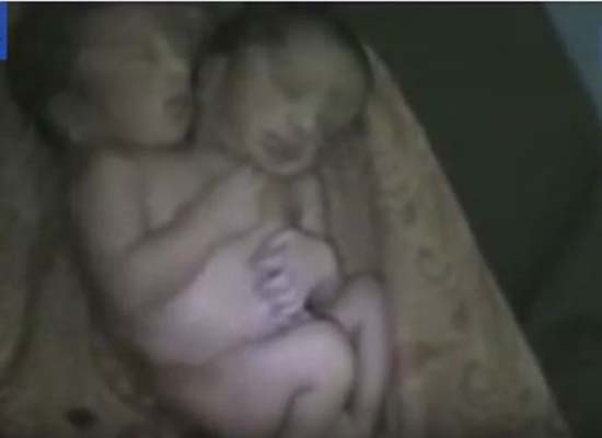 بالفيديو: ولادة نادرة لطفل برأسين في الهند