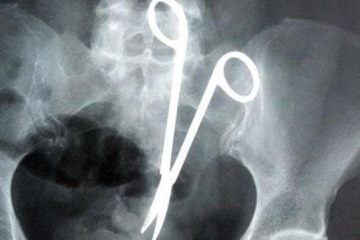 سيدة جزائرية عانت من آلام دامت لسنين بسبب مقص في بطنها!