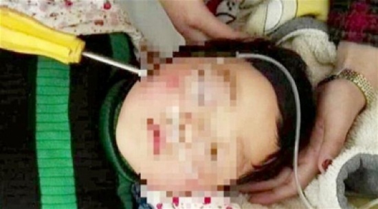بالصور /  نجاة طفلة من الموت بعدما اخترق مفك جمجمتها