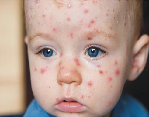 صحة جرش تنفي انتشار " جدري الماء " بين طلبة ساكب