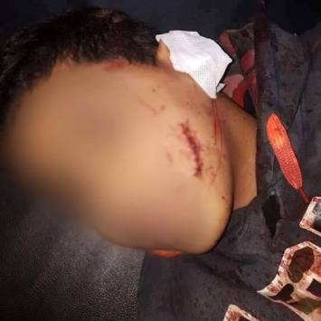 تشوه "وجه" حدث على يد شقيقين ..تفاصيل تشوه "وجه" حدث على يد شقيقين ..تفاصيل