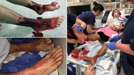 آكلات للحوم هاجمت مراهق وكادت تقتله نهشاً بقدميه دون أن يشعر بألم !!