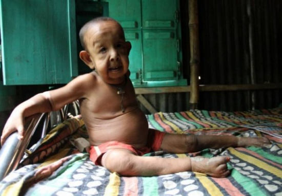 صور للطفل المسنّ الذي حيّر العالم!!