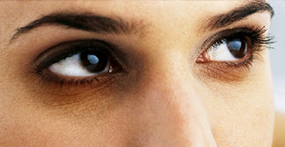 ما أسباب الهالات السوداء حول العين وطرق العلاج؟