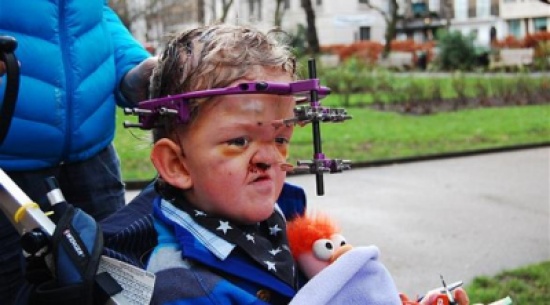 50 عملية جراحية لإعادة بناء وجه طفل