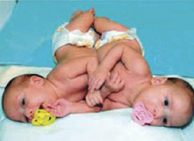 فصل التوأم السيامي الأردني