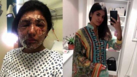ريشام الشجاعة وثّقت فترة علاجها... نشرت صوراً بعد تعرّضها لتشوّهات وحروق! ريشام الشجاعة وثّقت فترة علاجها... نشرت صوراً بعد تعرّضها لتشوّهات وحروق!