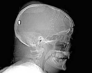 مسن روسي عاش 66 عاما برصاصة في رأسه