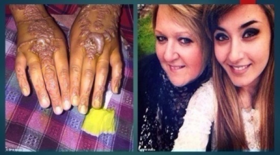 بالصور: مشاهد مرعبة لامرأة استخدمت حناء سوداء بالمغرب