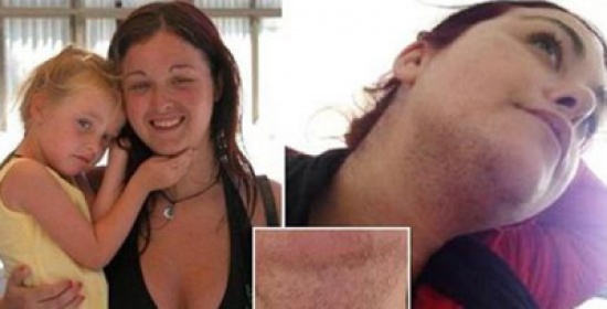 صور: بريطانية تحلق ذقنها 3 مرات يوميًا بسبب مرض نادر