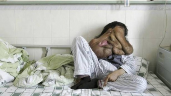 بالصور.. "الرجل الفيل" مصاب بأكبر ورم في العالم