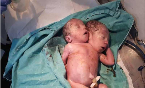 بالصور.. حالة نادرة لولادة طفل سوري "برأسين"