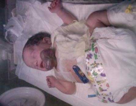 مولود باكستاني قلبه خارج جسده