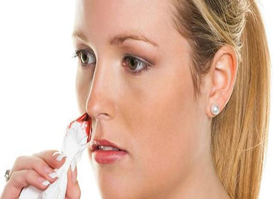 نزيف الأنف .. متى يستلزم استشارة الطبيب؟ نزيف الأنف .. متى يستلزم استشارة الطبيب؟