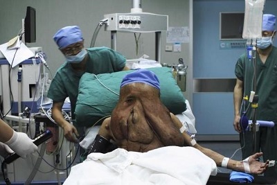 شاهد.."رجل الفيل" يخضع لإزالة 3 أورام من وجهه شاهد.."رجل الفيل" يخضع لإزالة 3 أورام من وجهه