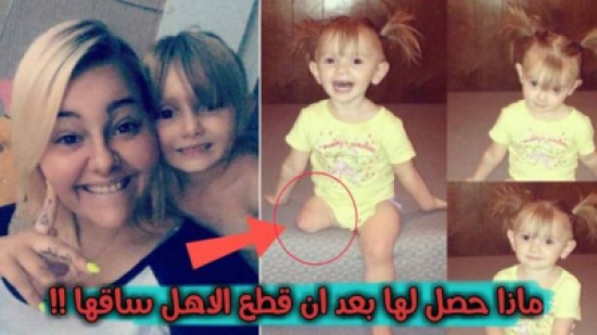شاهد: أصّر الأهل أن يقطعوا ساق ابنتهما رغم اعتراض الأطباء.. انظروا ما حدث لها !
