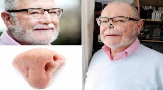 تركيب أنف مغناطيسي لمريض سرطان (صور)