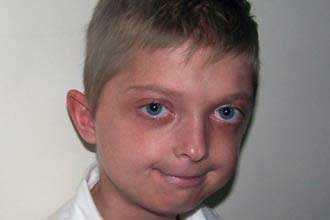 طفل يشيخ بسرعة الصاروخ.. والأطباء حائرون في لندن وواشنطن