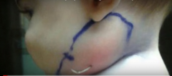 لاحظت شيئاً غريباً في خدّ طفلها.. وما اكتشفته كان غير متوقع!