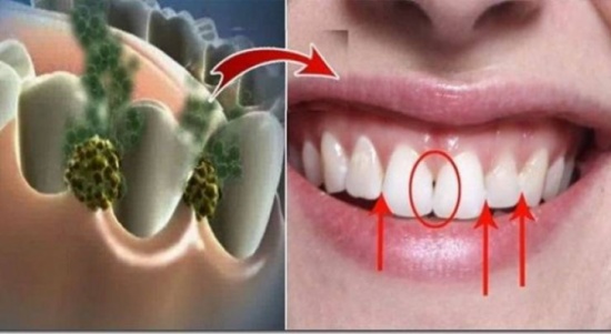 تخلصي من رائحة الفم الكريهة بهذه المكونات فقط! تخلصي من رائحة الفم الكريهة بهذه المكونات فقط!