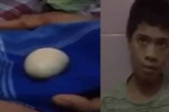 حالة نادرة.. طفل يبيض كالدجاج ويحير الأطباء حالة نادرة.. طفل يبيض كالدجاج ويحير الأطباء