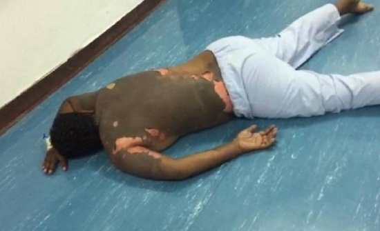 أهل الزوجة السعودية حارقة زوجها بالزيت المغلي يقلبون الطاولة بعد اشتراطه استعادة المهر للتصالح! أهل الزوجة السعودية حارقة زوجها بالزيت المغلي يقلبون الطاولة بعد اشتراطه استعادة المهر للتصالح!
