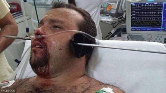 سهم يخترق رأس رجل وبقي على قيد الحياة!