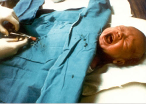 طبيبة باكستانية تحرم مولوداً من عضوه