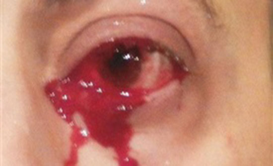 حالة غريبة لرجل يبكي دما بدل الدموع حالة غريبة لرجل يبكي دما بدل الدموع