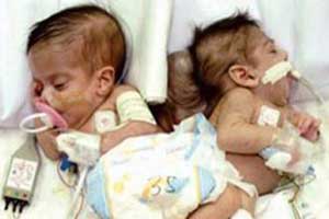 وفاة الطفلة السيامية "رقية" بعد 22 يوماً من فصلها عن أختها "زينب" 