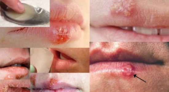 تخلصوا من قروح الفم المزعجة بمكون واحد فقط.. والنتيجة مذهلة! تخلصوا من قروح الفم المزعجة بمكون واحد فقط.. والنتيجة مذهلة!