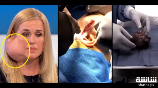 فيديو|كان حجم الإنتفاخ يكبر يوماً بعد يوم.. شاهد ماذا وجد الأطباء! فيديو|كان حجم الإنتفاخ يكبر يوماً بعد يوم.. شاهد ماذا وجد الأطباء!