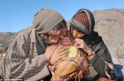بالصور..رجل بدون وجه .. وامرأة بقدم واحدة أنجبا طفلة جميلة بالصور..رجل بدون وجه .. وامرأة بقدم واحدة أنجبا طفلة جميلة