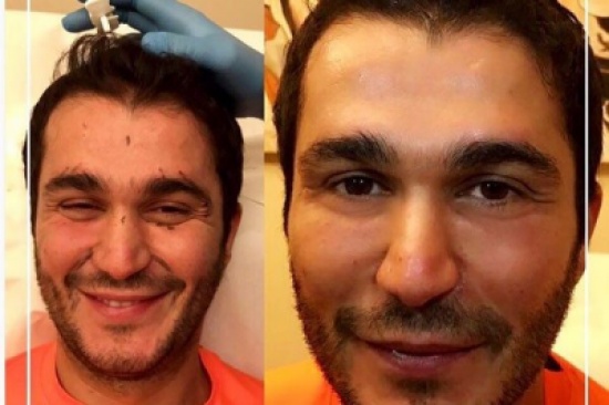 جورج الراسي يلجأ لحقن التجميل.. فيديو جورج الراسي يلجأ لحقن التجميل.. فيديو