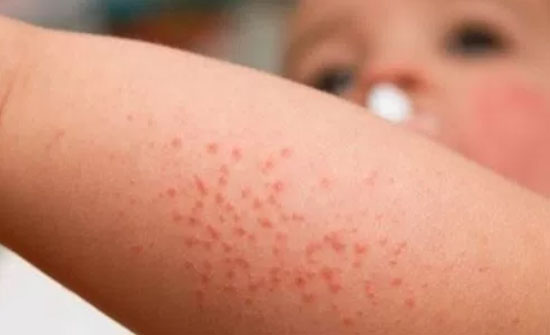 إربد: 19 إصابة بمرض "الجرب" في بني كنانة