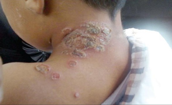 ثبوت إصابة 4 مواطنين باللشمانيا في أم السرب