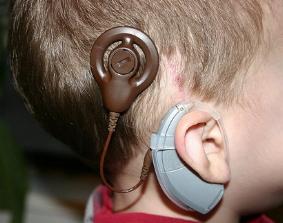 عمليات زراعة قوقعة لأطفال ضمن مبادرة "سمع بلا حدود"