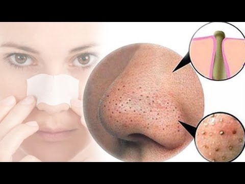 إليكم هذه الخدعة المعجزة لإزالة الرؤوس السوداء بدقائق قليلة! إليكم هذه الخدعة المعجزة لإزالة الرؤوس السوداء بدقائق قليلة!