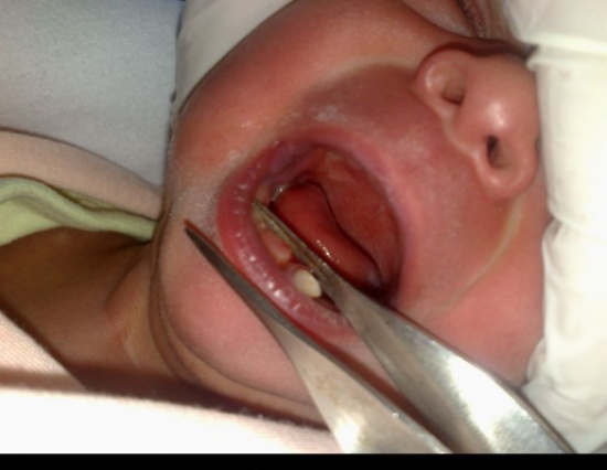 طفلة بريطانية تولد ولديها أسنان