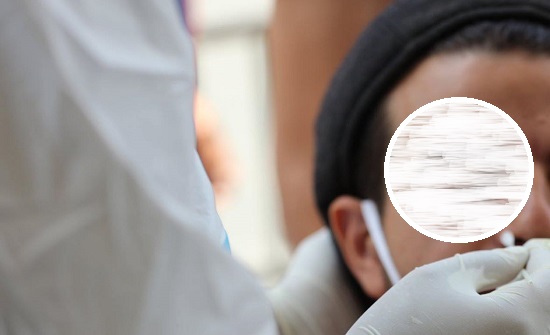 الرمثا: 42 عينة من مخالطي مصاب الرمثا سلبية