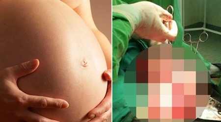 امرأة تكتشف أن حملها “ورم سرطاني” (صور)
