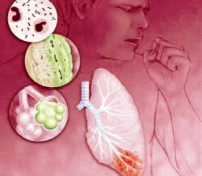 محاضرة في لواء القصر عن السل الرئوي