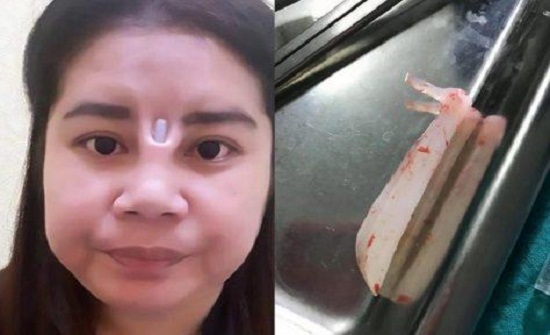 عملية تجميل فاشلة شوهت وجه فتاة عملية تجميل فاشلة شوهت وجه فتاة