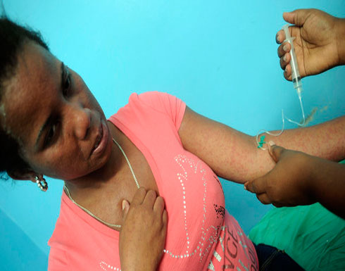 ظهور أول حالات إصابة بفيروس "شيكونجونيا" في أميركا